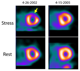 Stress and rest images of a DIAD patient The stress image in 2002 shows an area arrow with diminished blood flow violetslashblue evidence of silent CAD After three years of medical therapy the str