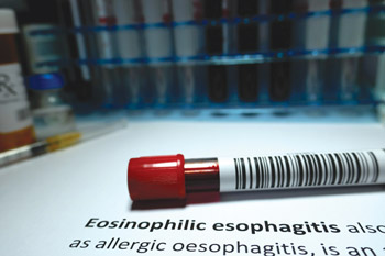 Rates of eosinophilic esophagitis have risen from four to 10 cases per 100000 persons in the 1990s and early 2000s to 50 to 100 cases per 100000 persons today Image by Hailshadow