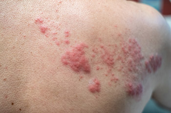 Theres greater awareness of shingles Everybody knows what that looks like and how debilitating it can be said Carolyn Bridges MD FACP Photo by Mumemories
